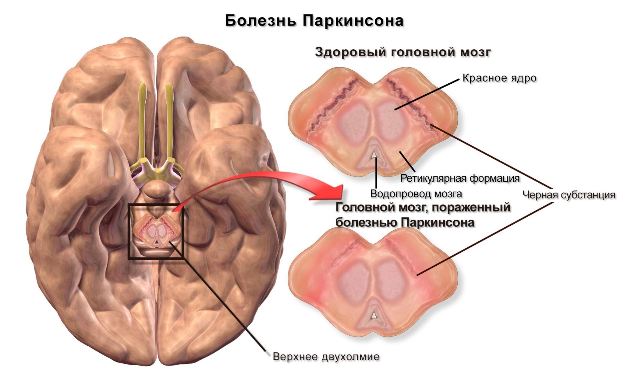 Болезнь паркинсона картинки